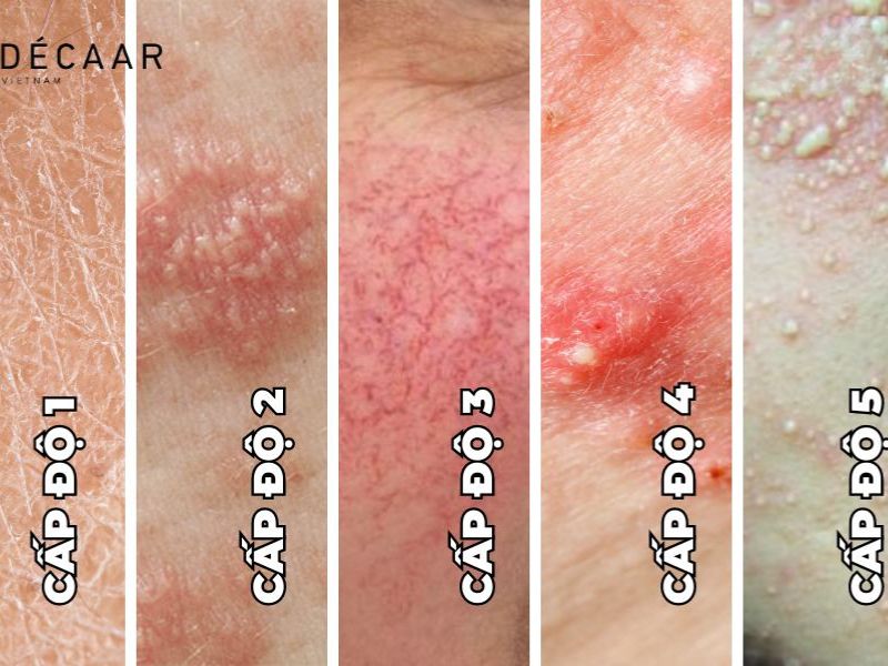 Biến chứng khi dùng cort